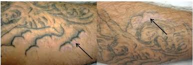 Some people with this skin condition do get tattoos. Hpv 47 Induced And Tattoo Associated Verrucae Planae Report Of A Case And Review Of The Literature Springerlink