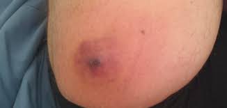 Your hair grows out of little pockets called follicles, the american if it does look like you're dealing with an infected ingrown hair, that's the time to call in a dermatologist, dr. Infected Ingrown Hair On My Leg I Only Got The Before Photo Once It Popped While I Was Getting Ready To Go To The Er It Popped On Me Popping