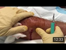 I made my way to the bathroom floor with intense abdominal pain that took my breath. Arm Infection And Sepsis Youtube
