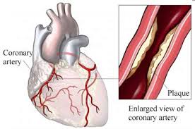 Image result for Angina Pectoris