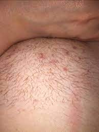 Other known cause of ingrown hair on pubic area will include Ingrown Hair Scars Warning Picture Included Glow Community