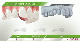 Die aligner werden mittels des computermodells individuell auf den patienten ausgerichtet. Clear Aligner Die Unsichtbare Zahnspange Ganz Klar