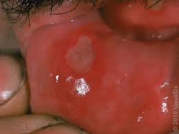 Image result for Canker sores symptoms roof of the mouth