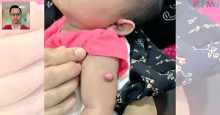 Jika anak puan baru mengalami demam dan kini mempunyai ruam, boleh jadi anak puan mengalami masalah yang dinamakan sebagai roseola, juga dikenali sebagai roseola infantum atau sixth disease. Lepas Suntik Bcg Memang Bernanah Tak Payahlah Letak Minyak Angin Atau Plaster Pa Ma