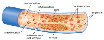 Was die körpergröße über gesundheitsrisiken aussagt. Was Ist Thrombose