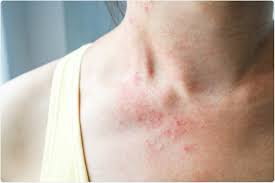It can also take longer before people show symptoms and people can be contagious for longer. Skin Rash May Be A Symptom Of Covid 19