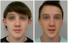 Santa Barbara, CA Ear Pinning