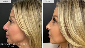 Expert Revision Rhinoplasty in Long Island, New York