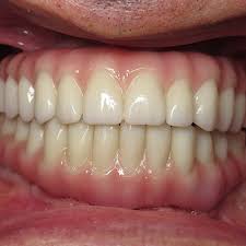 Shaping And Forming Gum Around Front Teeth Dental Implants Ramsey Amin Dds Reviews Ramsey A Amin Gum Disease Treatment Dental Implants Implant Dentistry
