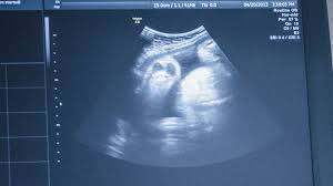 When And Why To Get Ultrasounds During Pregnancy The New York Times