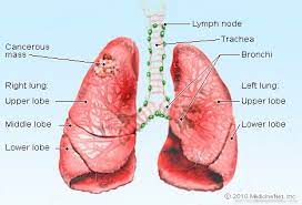 Pneumonia can be mild and only require a week of treatment before you can. Lung Cancer Vs Pneumonia Symptoms Signs Causes