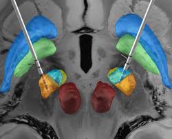 Dbs also maintains the adults' and children's barred lists and makes considered decisions as to whether an individual should be included on one or both of these lists and barred from engaging in. Lead Dbs A Matlab Toolbox Reconstruction And Visualization Of Dbs Electrodes Based On Postoperative Imaging