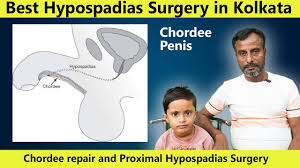 Image result for Chordee