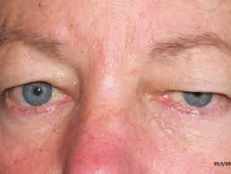 Botulism is a rare but serious illness caused by toxins released by bacteria called clostridium foodborne botulism occurs by consuming contaminated foods or inhaling the spores of the bacteria. Botulinum Toxin Dermnet Nz