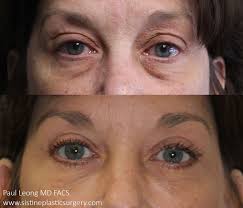 Before After Blepharoplasty Upper Eyelid Lift Dr Leong Sistine Plastic Surgery Pittsburgh Pa Facial Applying Eye Makeup Eye Makeup Fairy Eye Makeup