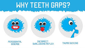 If you find yourself often waking up to a sore jaw, headache. How To Fix Gap In Front Teeth Without Braces