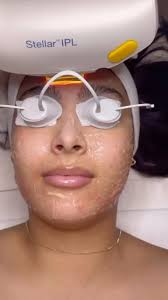 One amazing treatment, endless good vibes. Book a Stellar M22 IPL treatment  today, #stellar #beautytechforlife #lumenis #ipl #brownspots #redness  #wrinkles #acne #veins #esthetics #laser , repost ...