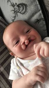 Cleft Lip And Palate Association