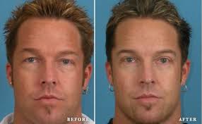 Blefaroplastia Antes E Depois Cirurgia Rejuvenescedora