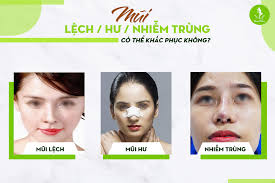 NÂNG MŨI SỤN SƯỜN BỊ BIẾN CHỨNG PHẢI LÀM SAO?