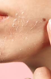 Image result for Dry Skin
