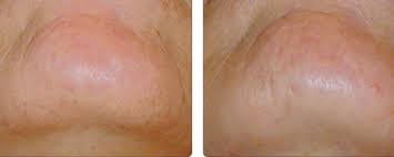 Ingrown hairs are less of an issue with epilation than they are with shaving, although they can certainly still occur. The Best Facial Epilator Plus Tips On How To Use It Bellatory