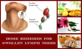 Home Remedies For Swollen Lymph Nodes Swollen Lymph Nodes Natural Headache Remedies Lymph Nodes