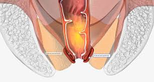 Image result for Fecal Incontinence