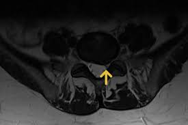 Erosive Osteochondrose Gemeinschaftspraxis Fur Neurochirurgie