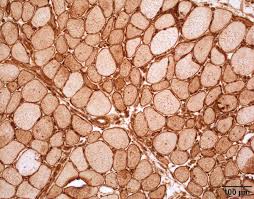 Image result for Polymyositis