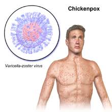 Primary varicella infection (chickenpox) was not reliably distinguished from smallpox until the end of the 19th century. Chickenpox Wikipedia