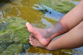 Image result for Pigment stains on the shin