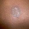 The only one of those that is still common in the states is black dot, but all are found around the world. 1