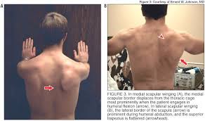 Scapular winging in itself is not classified as a medical injury, it is just a symptom of another condition (we will discuss these conditions down below). Scapular Winging Shoulder Elbow Orthobullets