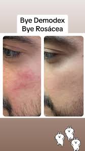 Image result for demodex rosacea