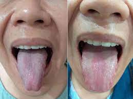 名醫會客室／舌痛病因多拖越久越複雜