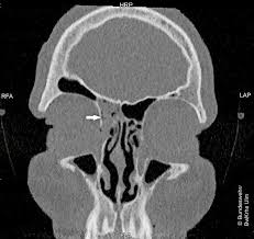 Die zerebrale sinusvenenthrombose (csvt) zählt zu den selteneren formen zerebrovaskulärer erkrankungen und betrifft vor allem jüngere frauen. Wehrmedizin