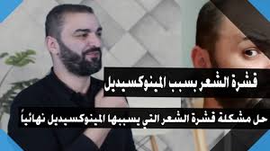 قشرة الشعر بسبب المينوكسيديل الاسباب والحلول Youtube