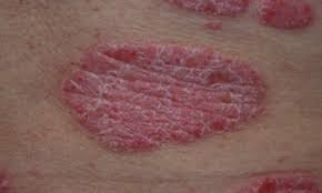 Image result for psoriasis