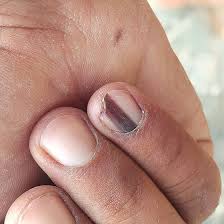 Image result for Acral lentiginous melanoma nail