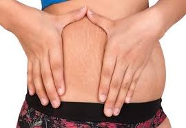 Catlaklara Ne Iyi Gelir Vucutta Olusan Catlaklara Dogal Tedavi Yontemleri