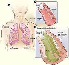 There are a few more than 0different species of palms, but they typically produce just a few basic patterns of leaves. Bronchiectasis Wikipedia