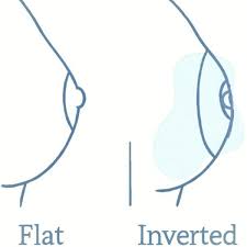 Image result for Nipple Inversion