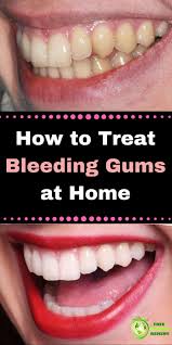 How To Stop Teeth Bleeding Immediately Arxiusarquitectura