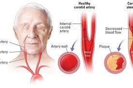 Image result for carotid artery