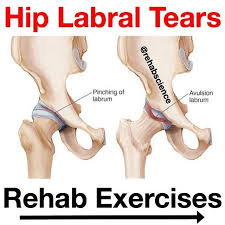 Pin On Hip Pain
