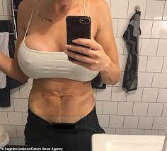 Ganske greit om du vippsa;) selge kle som ikkje blir brukt eller lite brukt kjøper betaler frakt. Mother Of Two S Breast Implants Fall Out Of Her Chest After Botched Surgery In Turkey Daily Mail Online