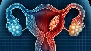 Some early symptoms include unusual bleeding and discharge, and early treatment can dramatically improve the outlook. Uterine Cancer Warning Signs To Watch For