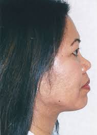 Rhinoplasty Surgery Procedure