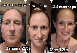 Hello all you beautiful ladies! Has anyone had Dr. Medling in Tennessee do  their explant surgery? Thank you 😊